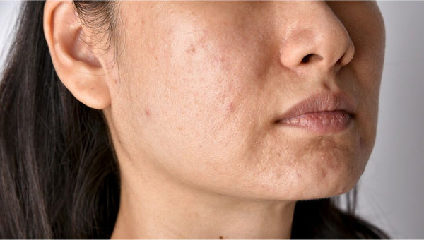 Dirty & Clogged Skin